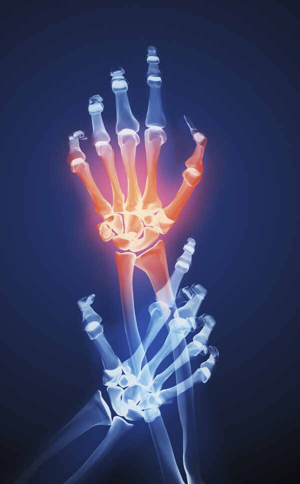 人体手腕X光透视图图片