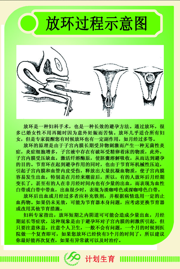 計(jì)劃生育放環(huán)示意圖
