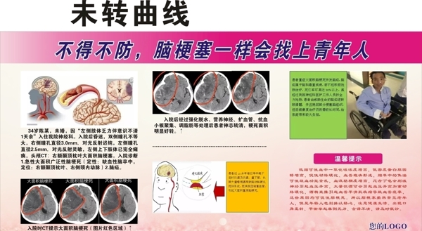 腦梗塞