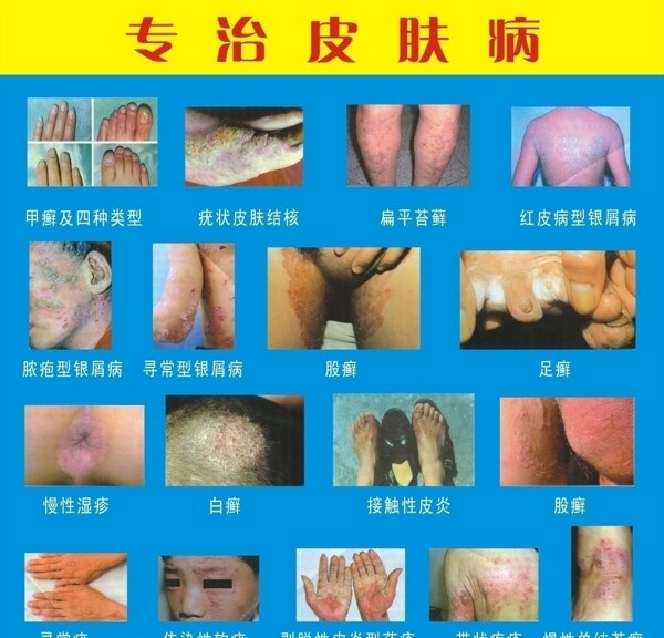 皮膚病圖片