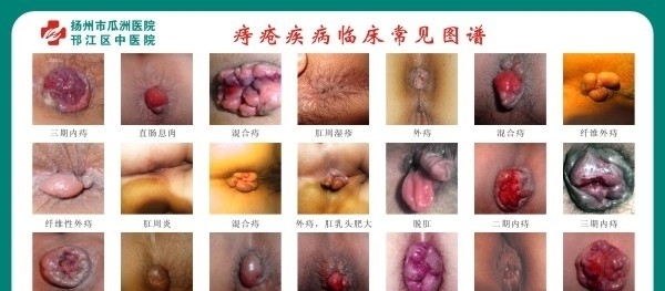 痔疮临床常见图图片