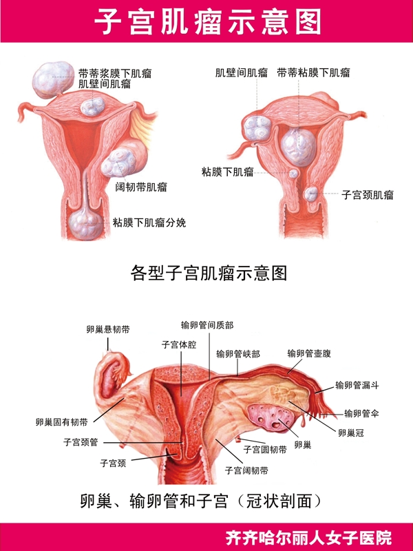 子宫肌瘤挂图图片